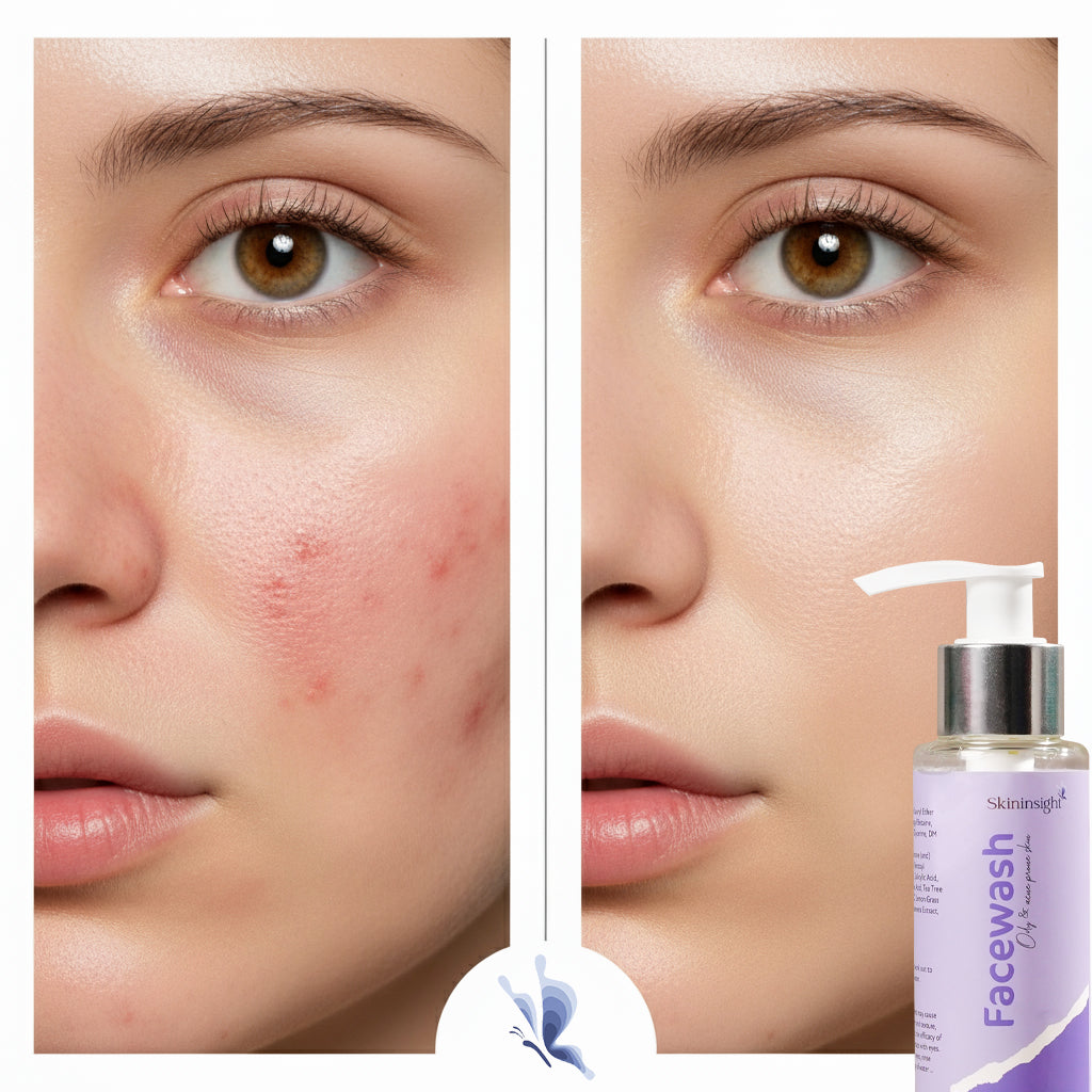 Skininsight Acne-Fighting Facewash – BHA + AHA + Tea Tree Cleanser for Oily & Acne-Prone Skin (100ml)